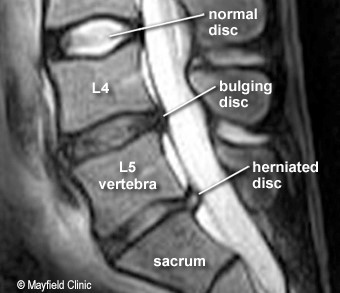 hernie a durerii coloanei vertebrale în articulațiile genunchiului)